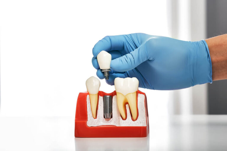 Dentist showing the installation of a dental implant