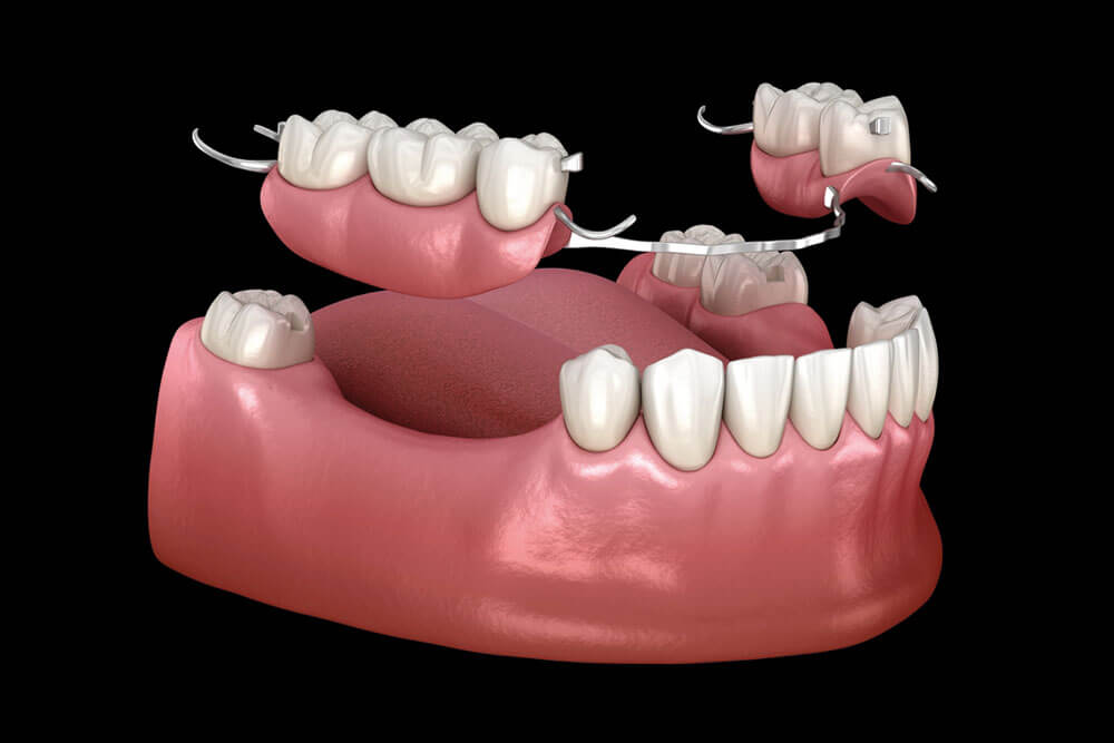 Removable partial denture, mandibular prosthesis.