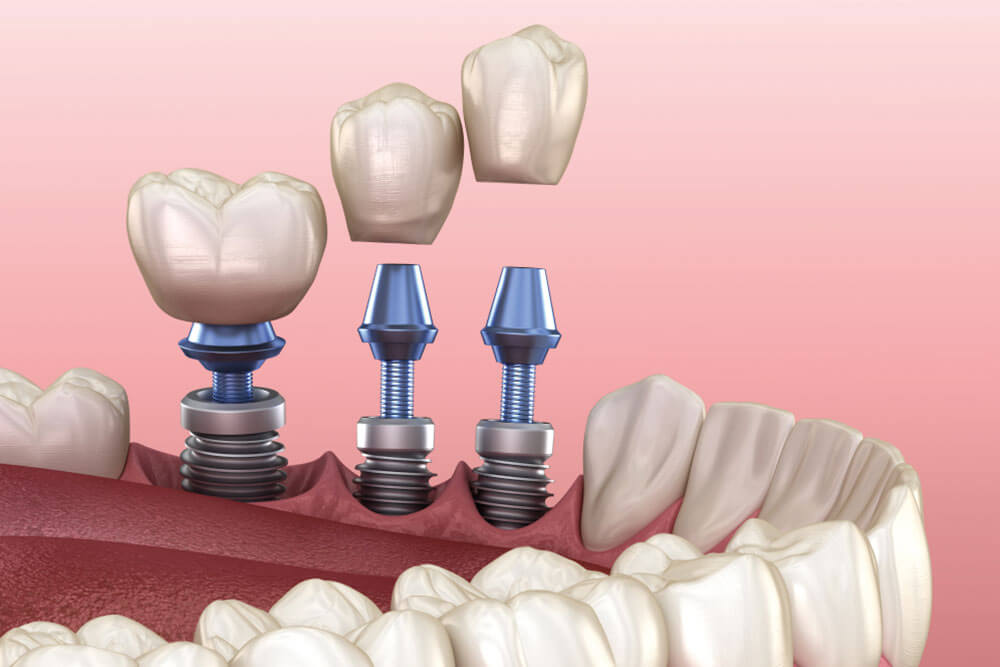 3D illustration of human teeth and dentures