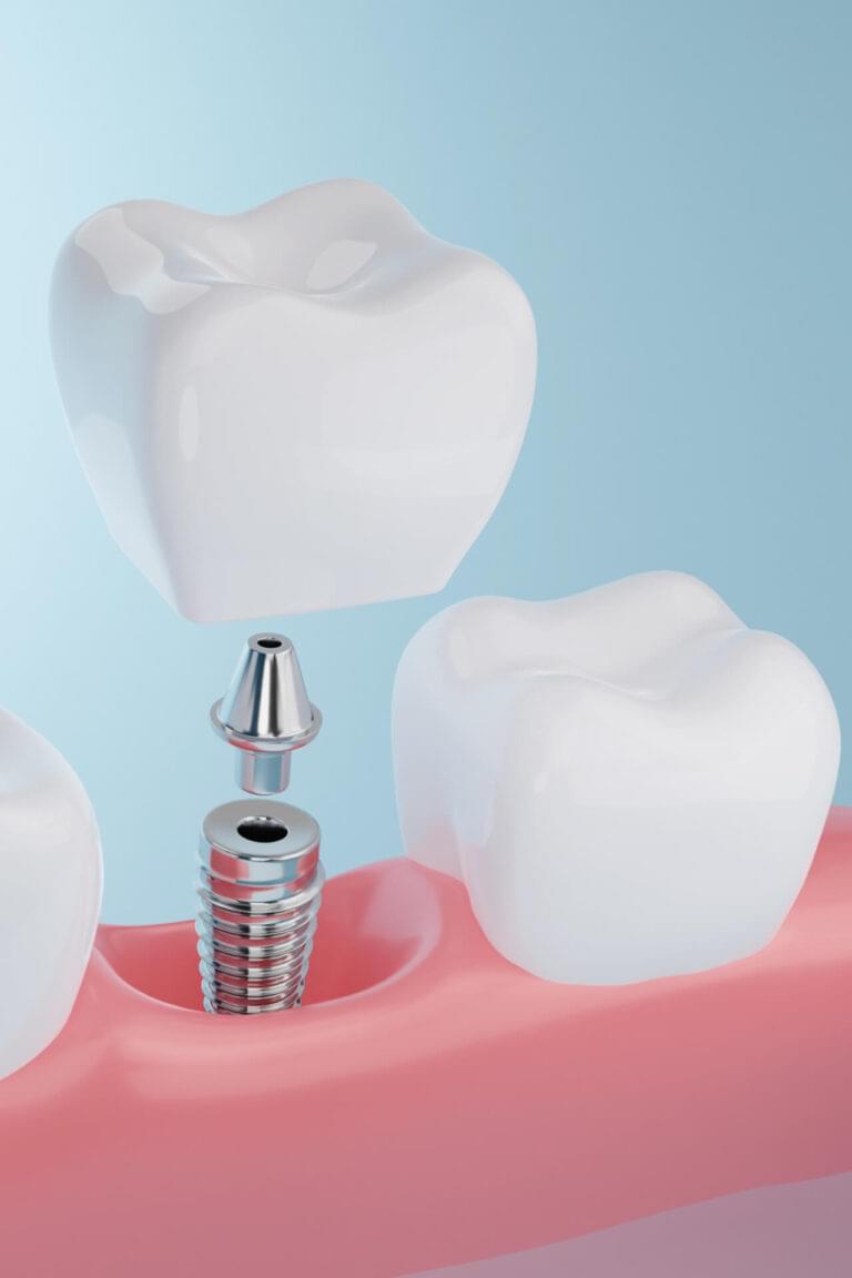 Healthy gums and Dental implant