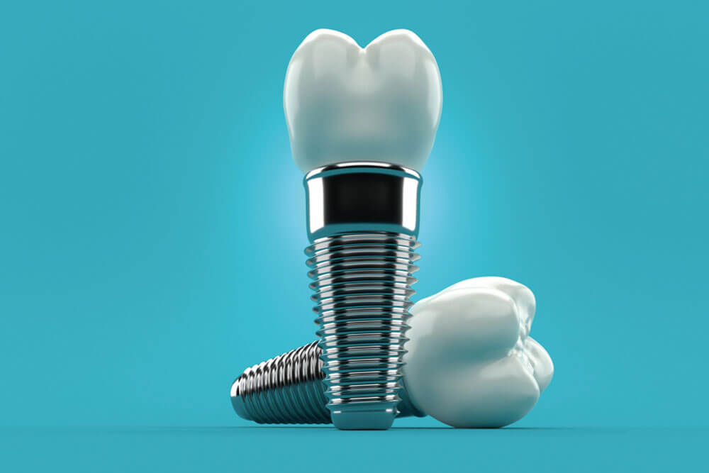 Dental implants on blue background. 3d illustration