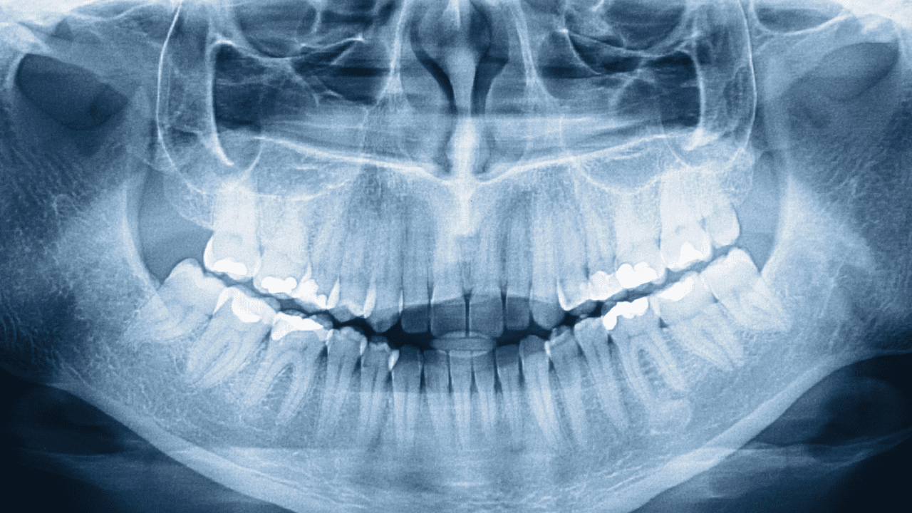 Are teeth bones? What are Dental Implants