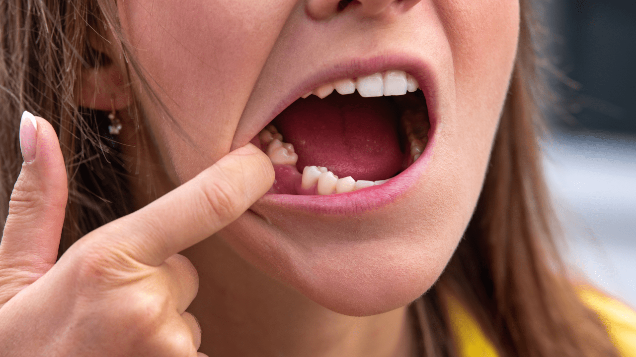 Regrow Missing Teeth Naturally