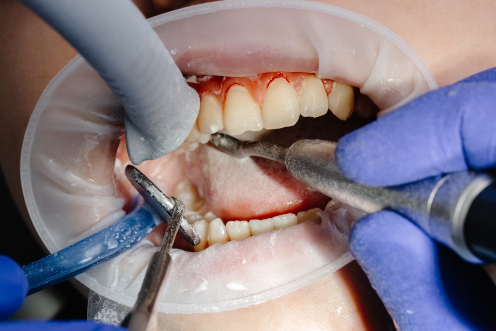 dentist performing dental checkup cleaning teeth