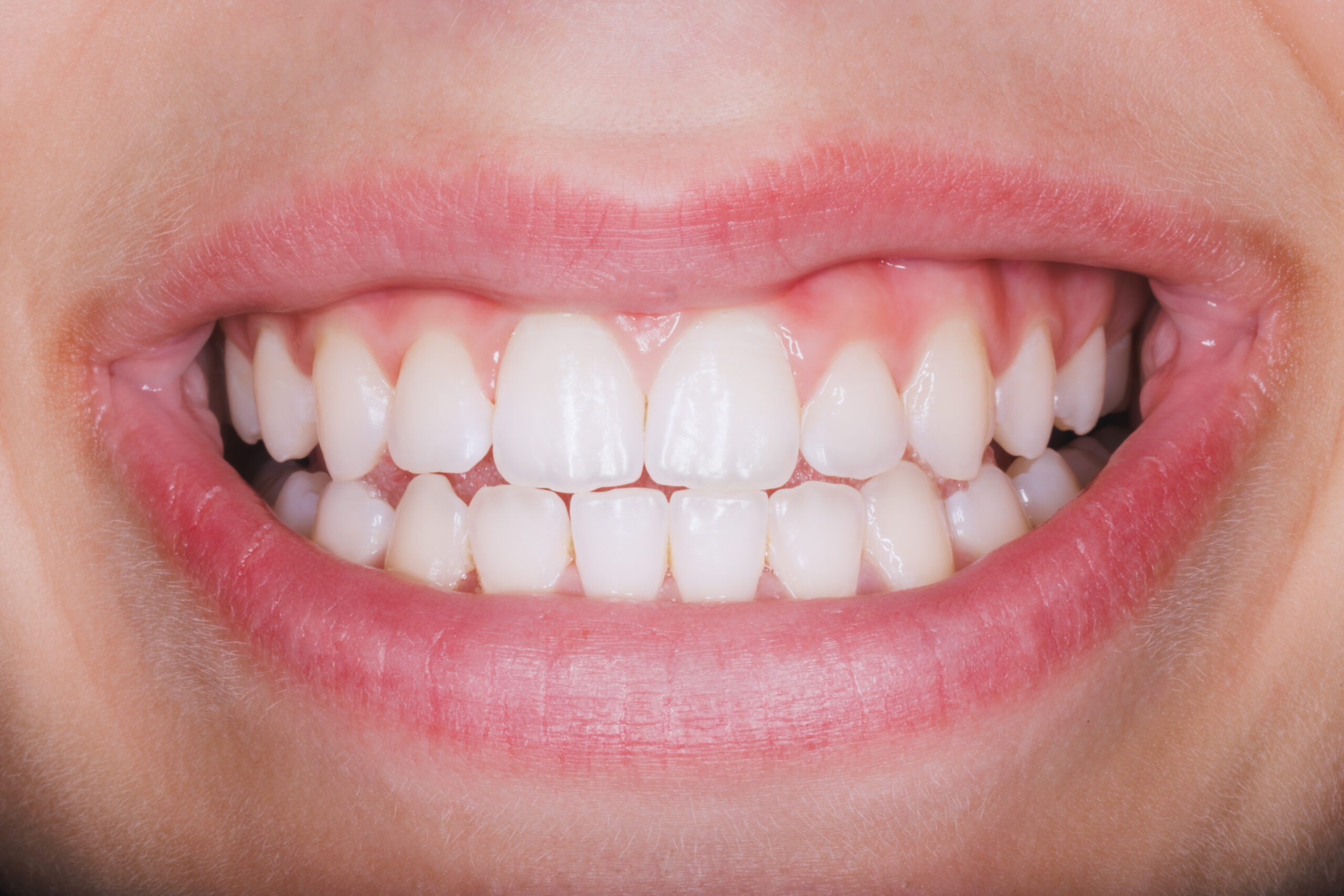 Close-up of a smiling mouth showing clean, white teeth and healthy gums.